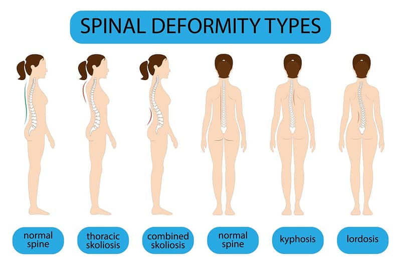 Spinal Deformity Types